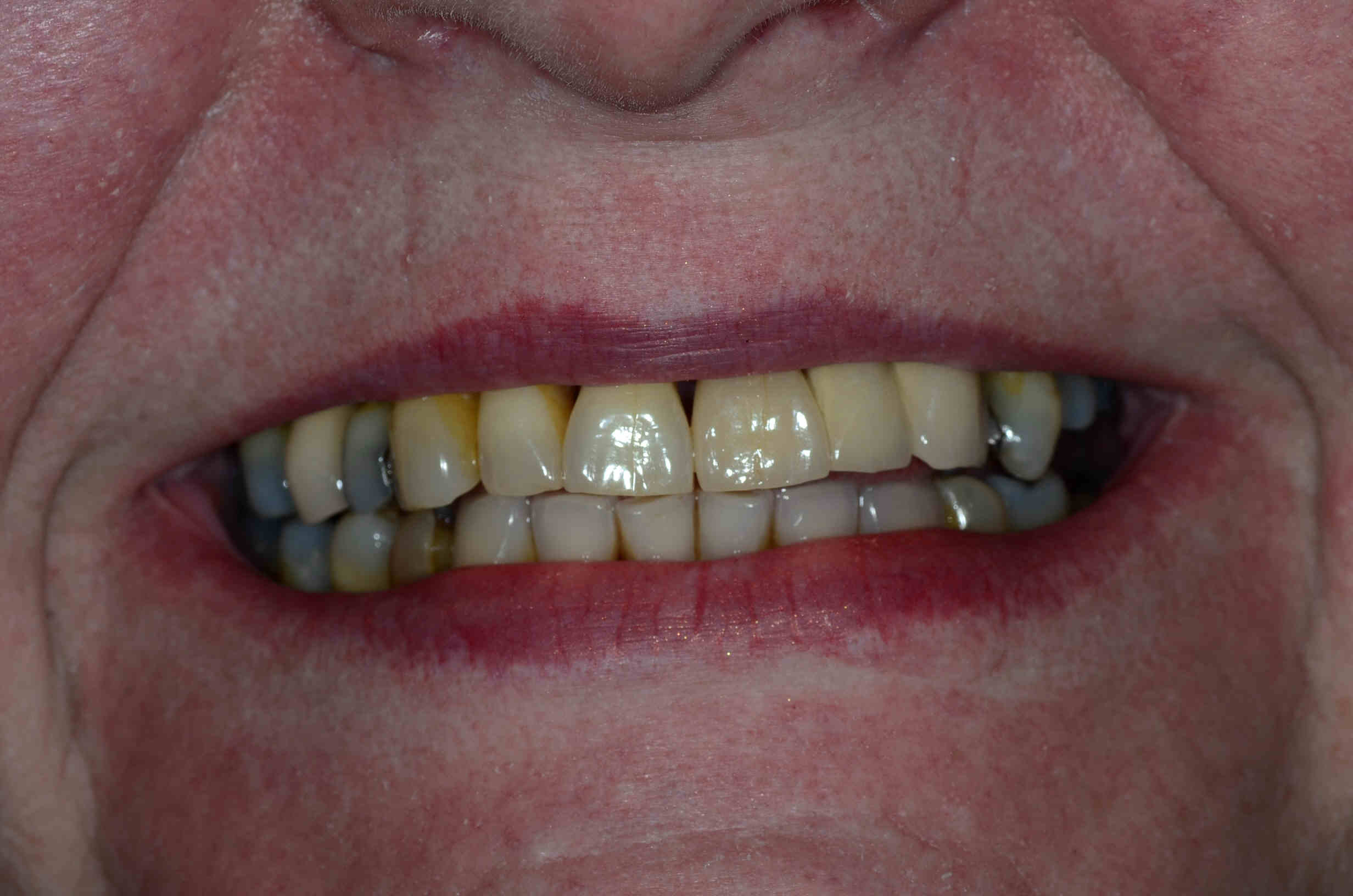 Dental Implants in Nottingham The Campbell Clinic